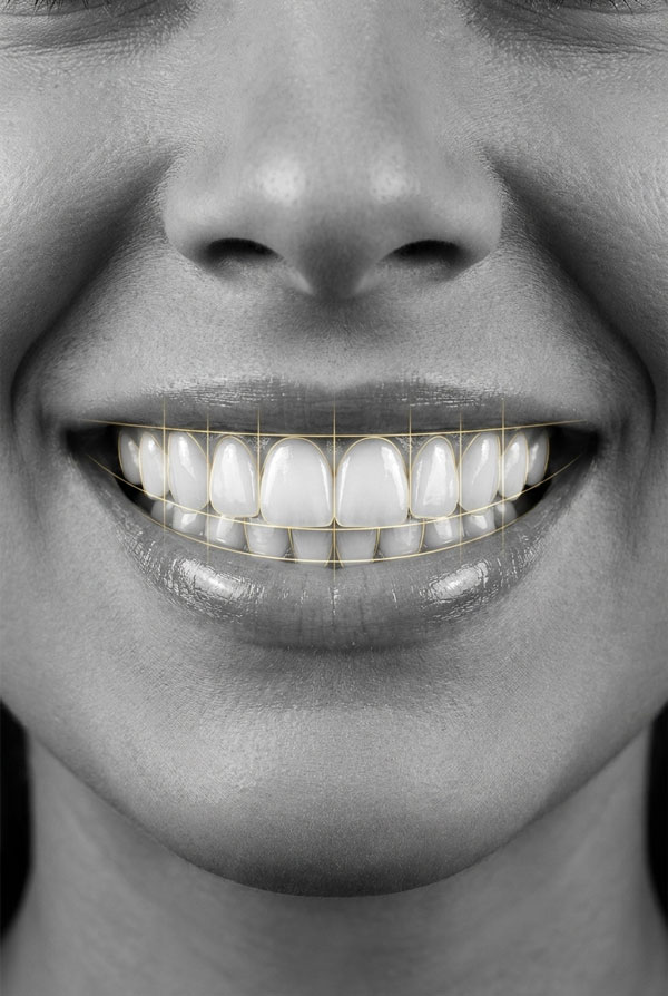 بازسازی و طراحی لبخند در اصفهان