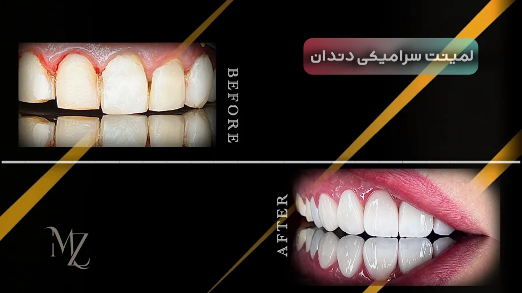 لمینت دندان در اصفهان