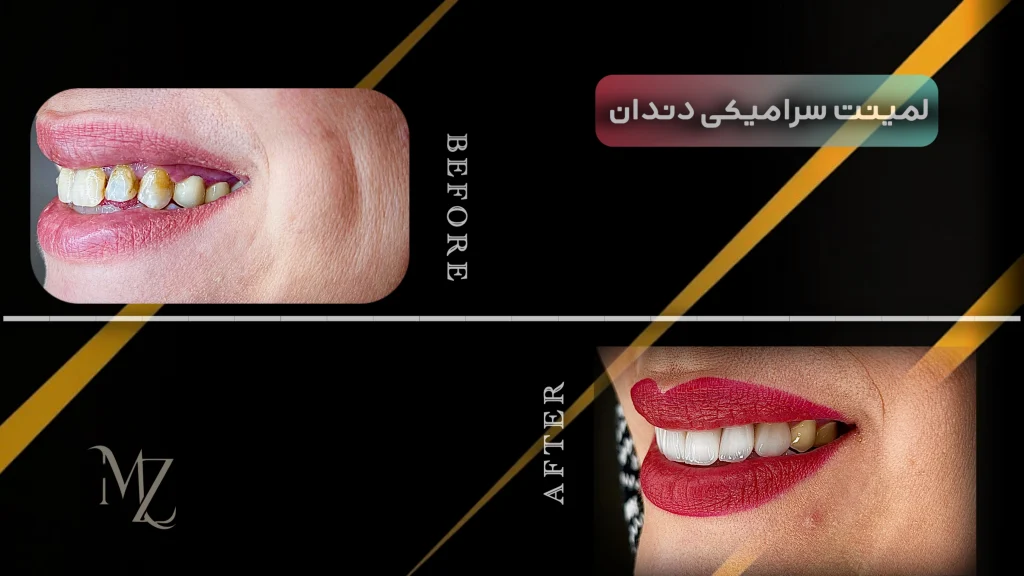 لمینت دندان در اصفهان