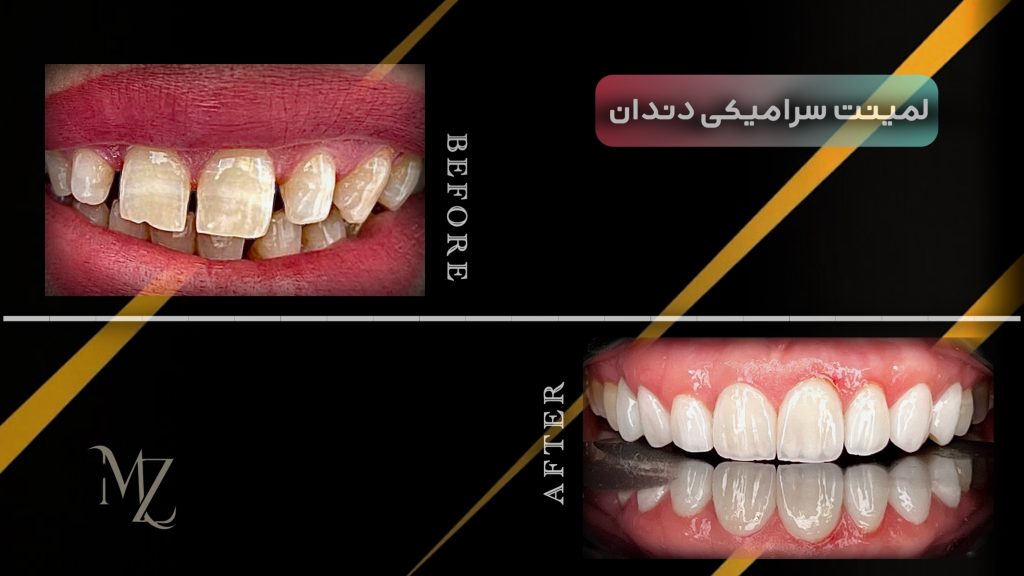 لمینت دندان در اصفهان