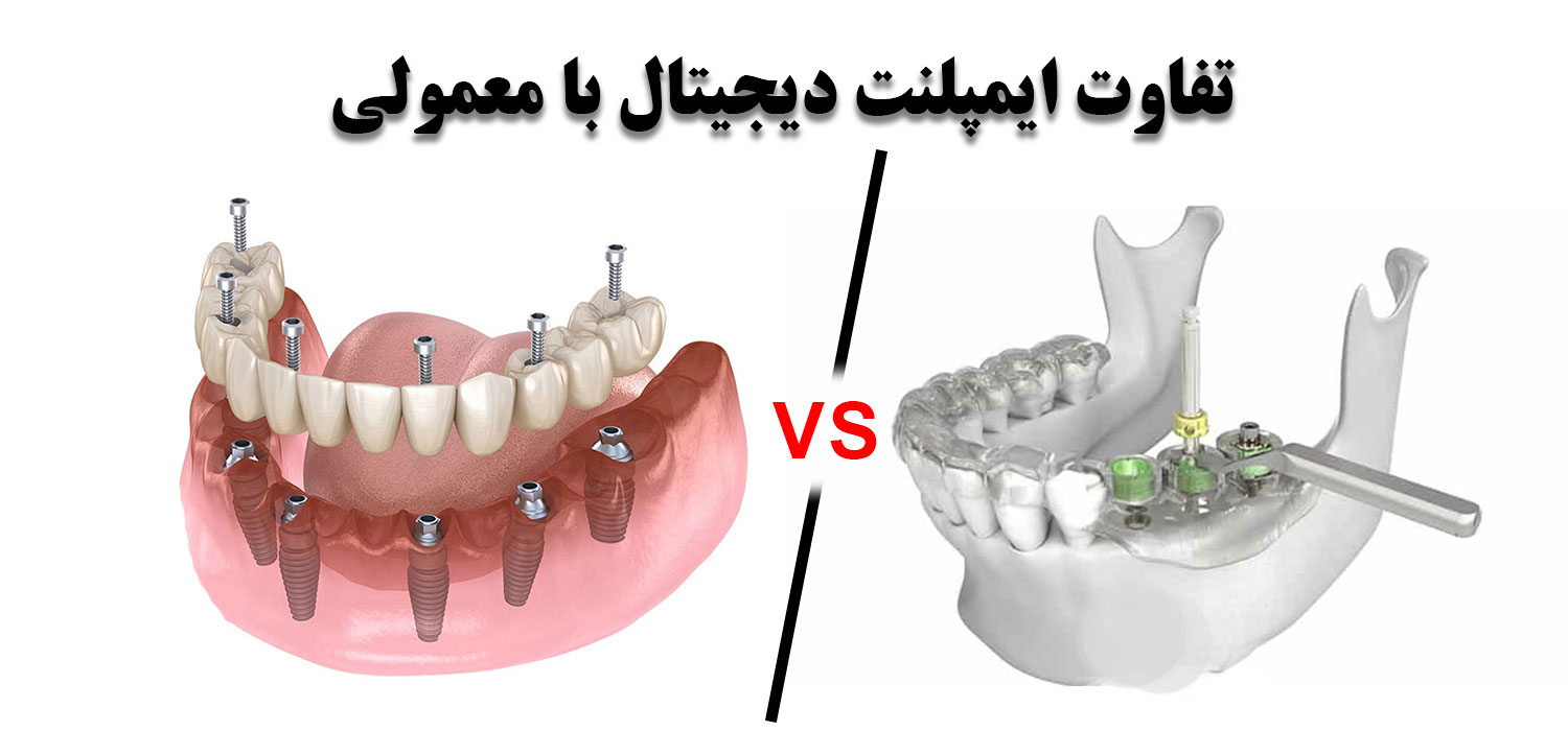 تفاوت ایمپلنت دیجیتال و معمولی