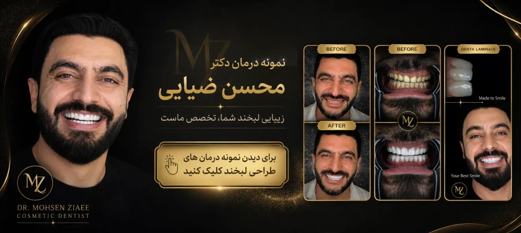 ونیر کامپوزیت در اصفهان