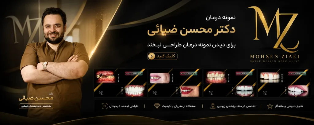 بلیچینگ دندان در اصفهان