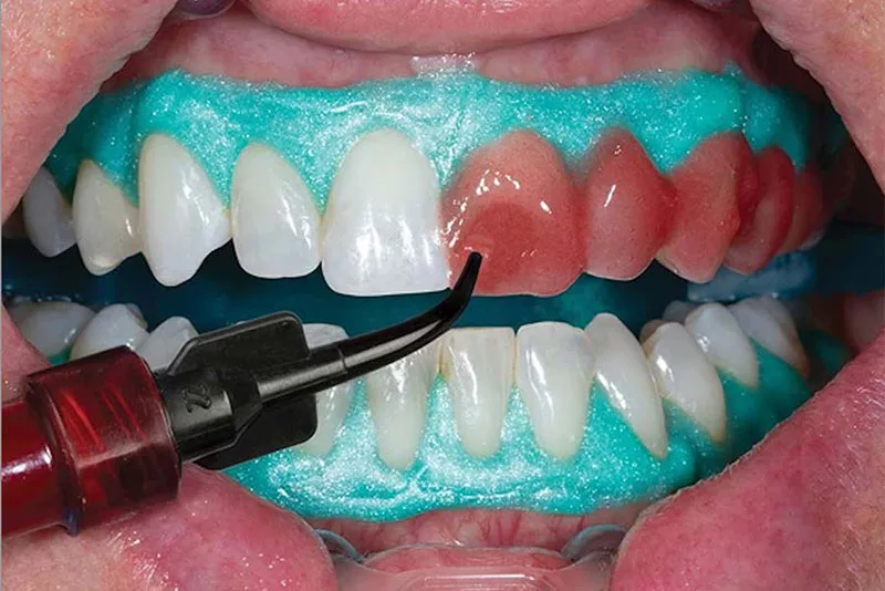 تفاوت بلیچینگ در مطب و خانه