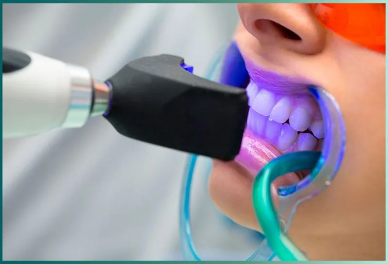 تفاوت بلیچینگ در مطب و خانه