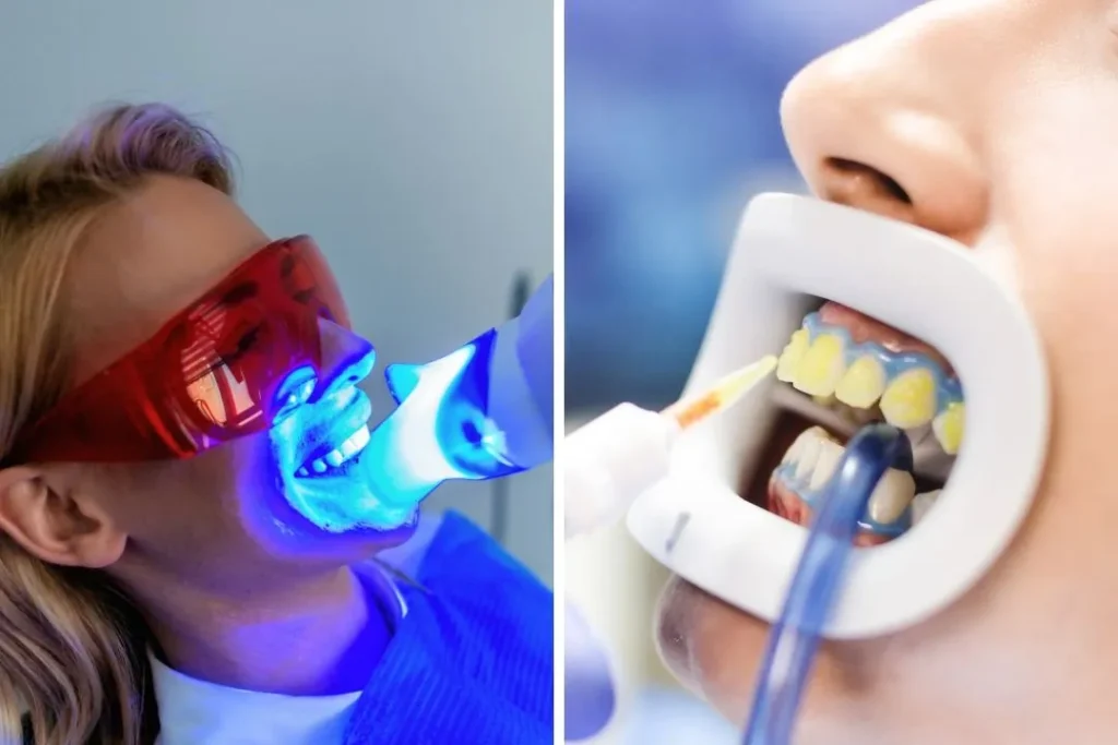 بلیچینگ دندان بهتر است یا لمینت؟