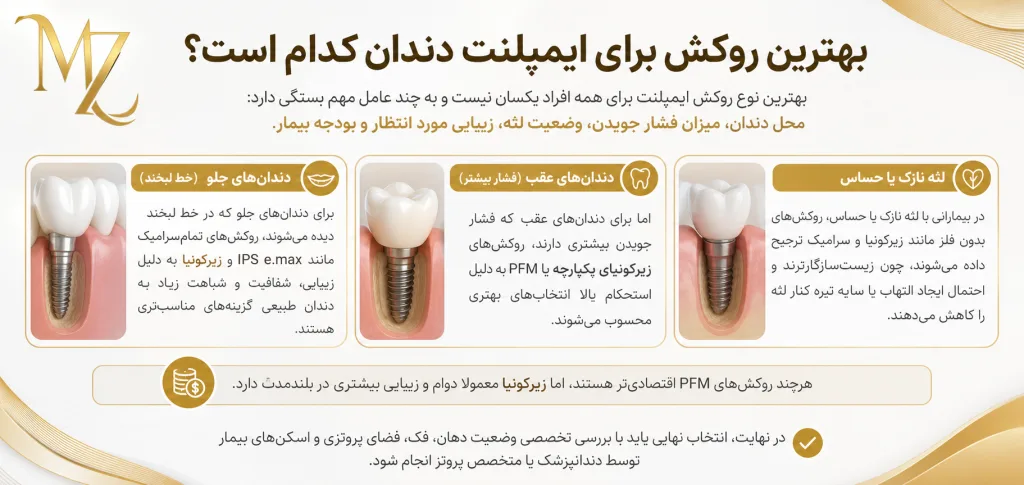 روکش ایمپلنت در اصفهان