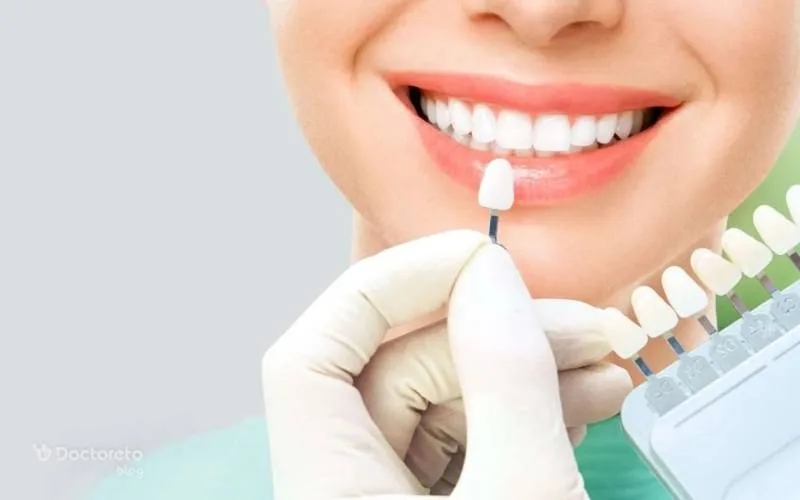 کامپوزیت ونیر چیست؟