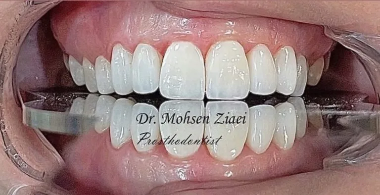لمینت دندان در اصفهان