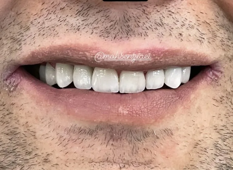لمینت دندان در اصفهان
