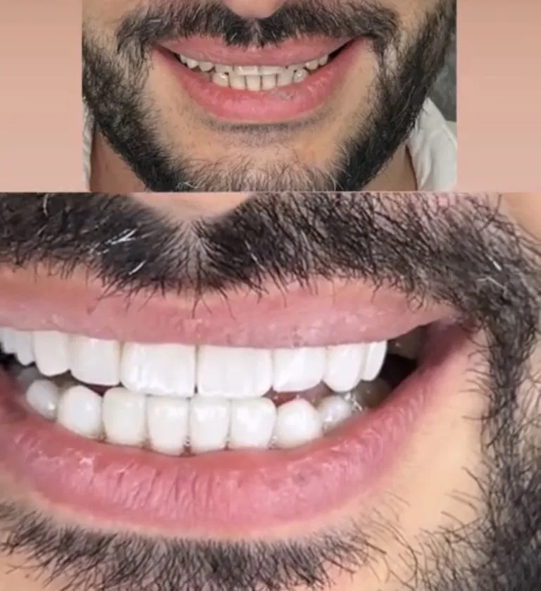 لمینت دندان در اصفهان