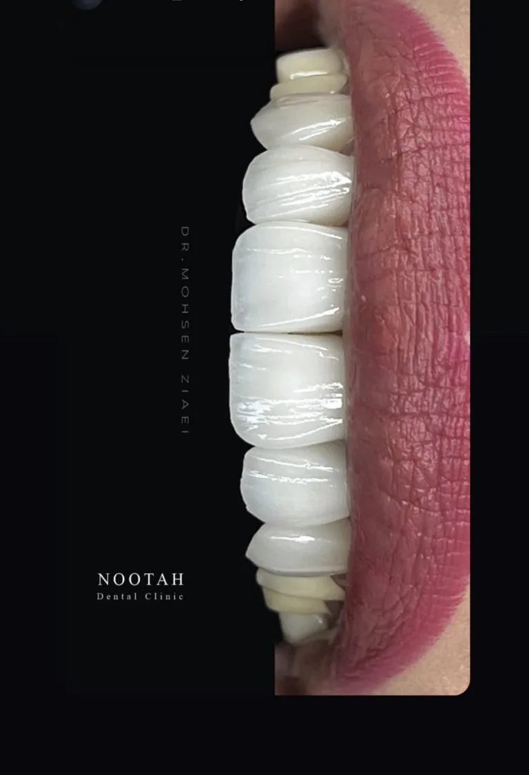 لمینت دندان در اصفهان