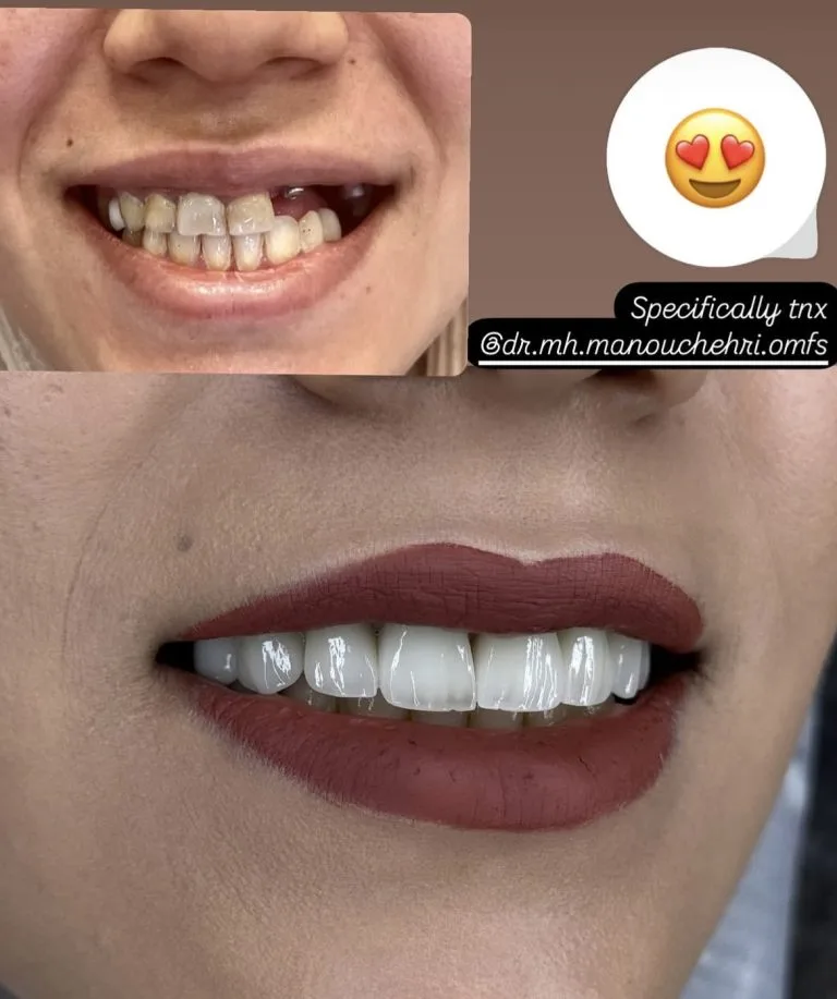 لمینت دندان در اصفهان