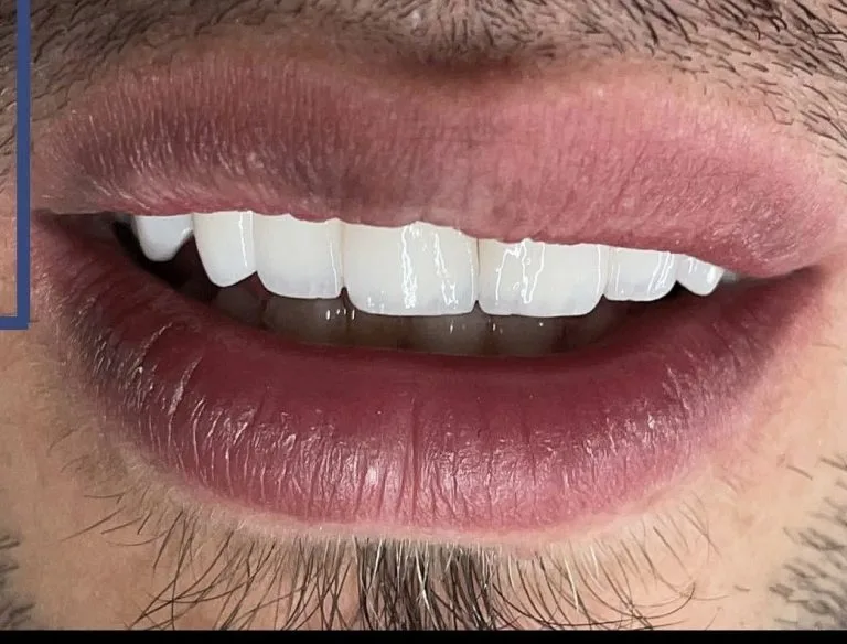 لمینت دندان در اصفهان