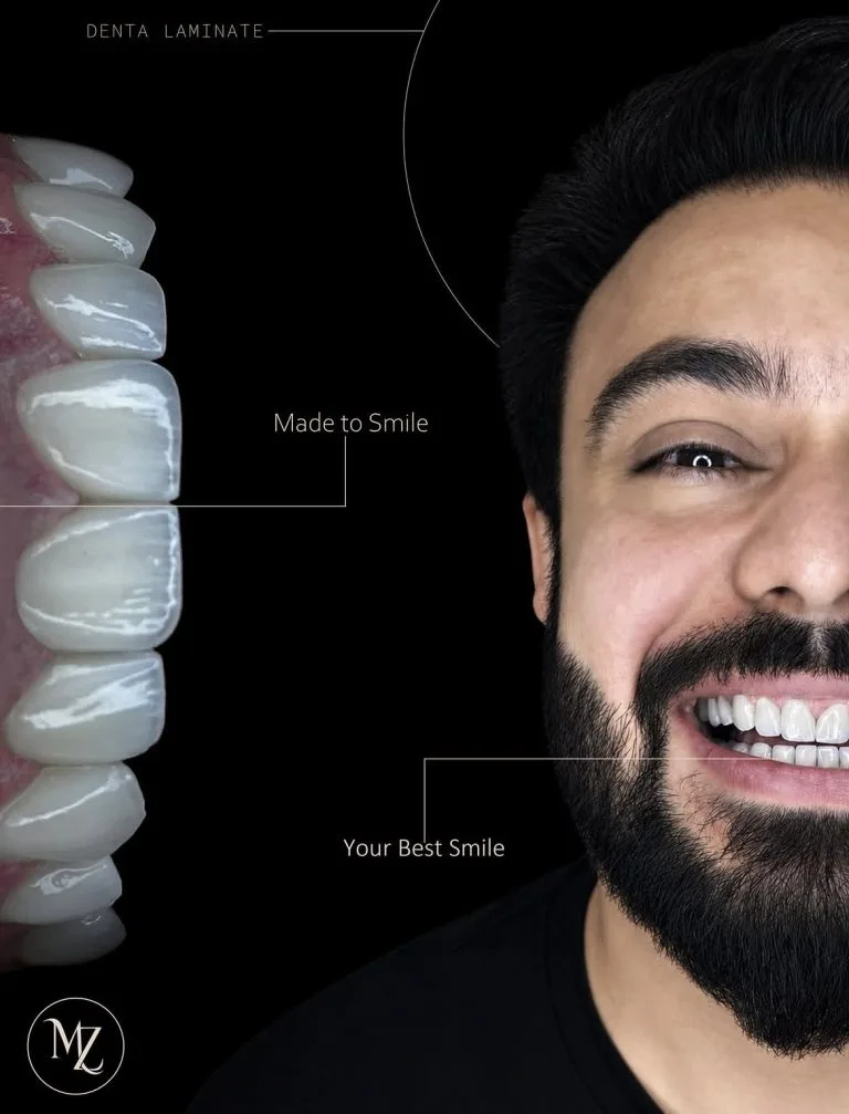 لمینت دندان در اصفهان