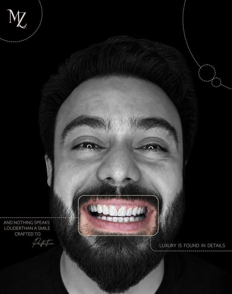 لمینت دندان در اصفهان