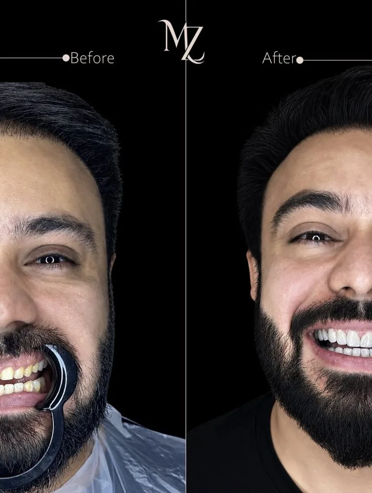 لمینت دندان در اصفهان