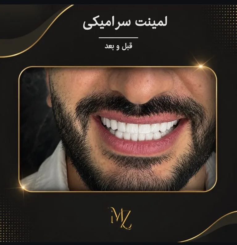 لمینت دندان در اصفهان