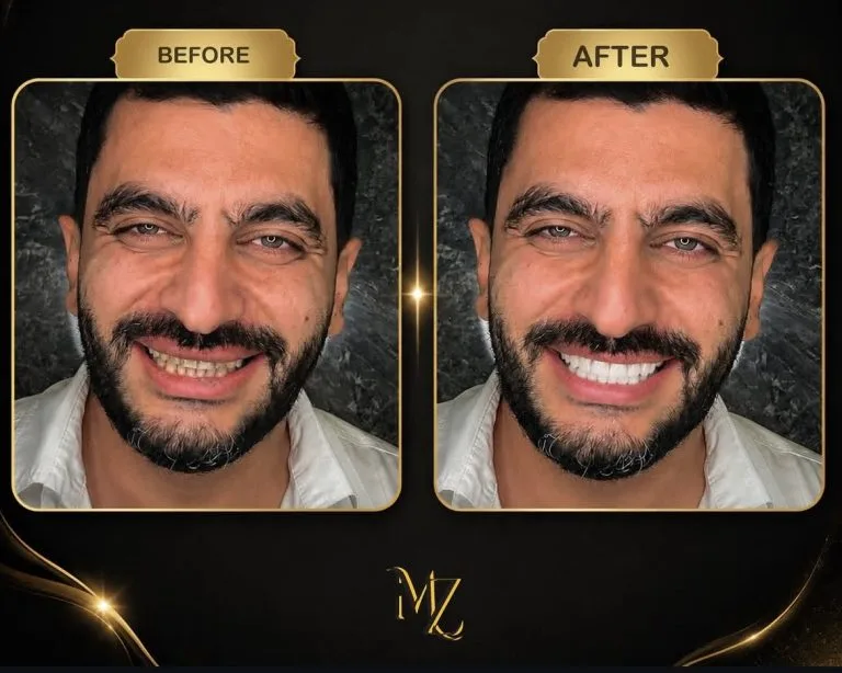 لمینت دندان در اصفهان