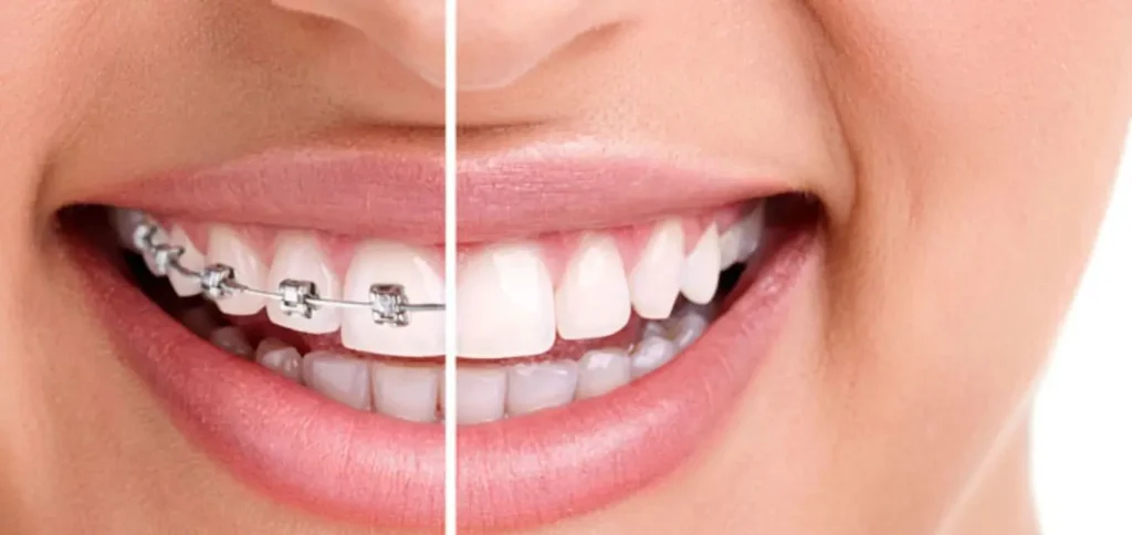 برای اصلاح لبخند ارتودنسی بهتر است یا لمینت؟